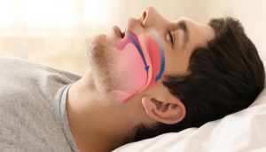 tìm hiểu ngưng thở khi ngủ